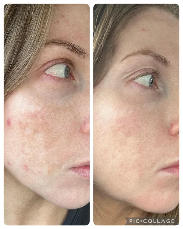 Customer before-and-after skincare photos, pair 1